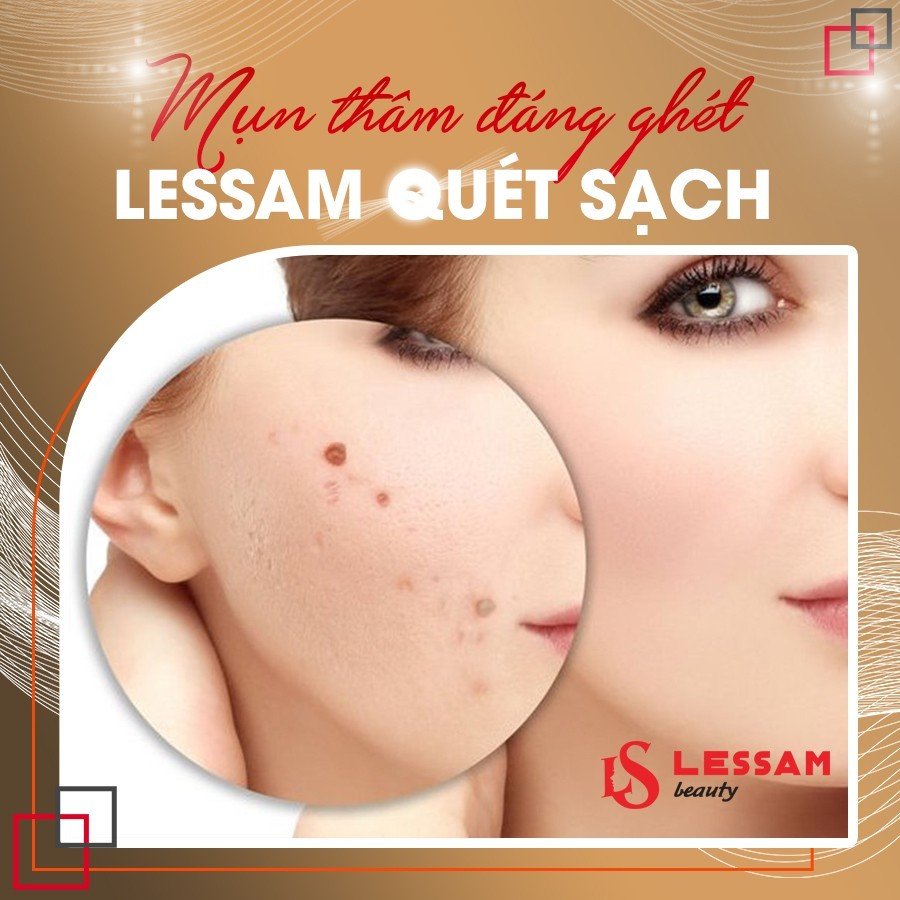 Điều trị mụn thâm tận gốc uy tín nhất Phú Nhuận - Viện thẩm mỹ Les Sam