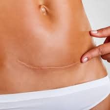 Sinh Mổ Bao Lâu Thì Mới Nên Có Thai Lại? Những Điều Cần Lưu Ý Khi Mang Thai Sau Sinh Mổ