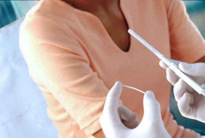 Cấy Que Tránh Thai: Giải Pháp Ngừa Thai Hiện Đại Cho Phụ Nữ Bận Rộn