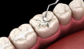 Top 3 đơn vị nha khoa chuyên trám răng giá rẻ chất lượng tại quận 5