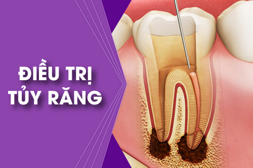 TOP PHÒNG KHÁM ĐIỀU TRỊ TỦY RĂNG CHẤT LƯỢNG TẠI TP. HỒ CHÍ MINH