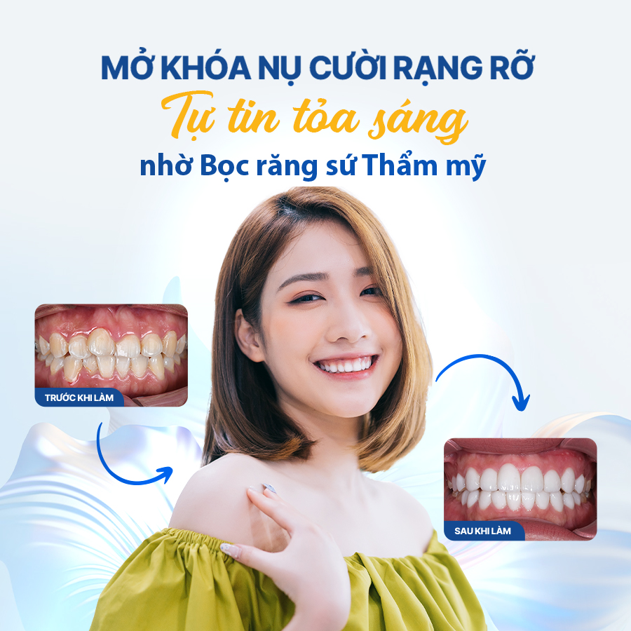 Top 3 Dịch Vụ Sứ Thẩm Mỹ Uy Tín Tại Quận 1