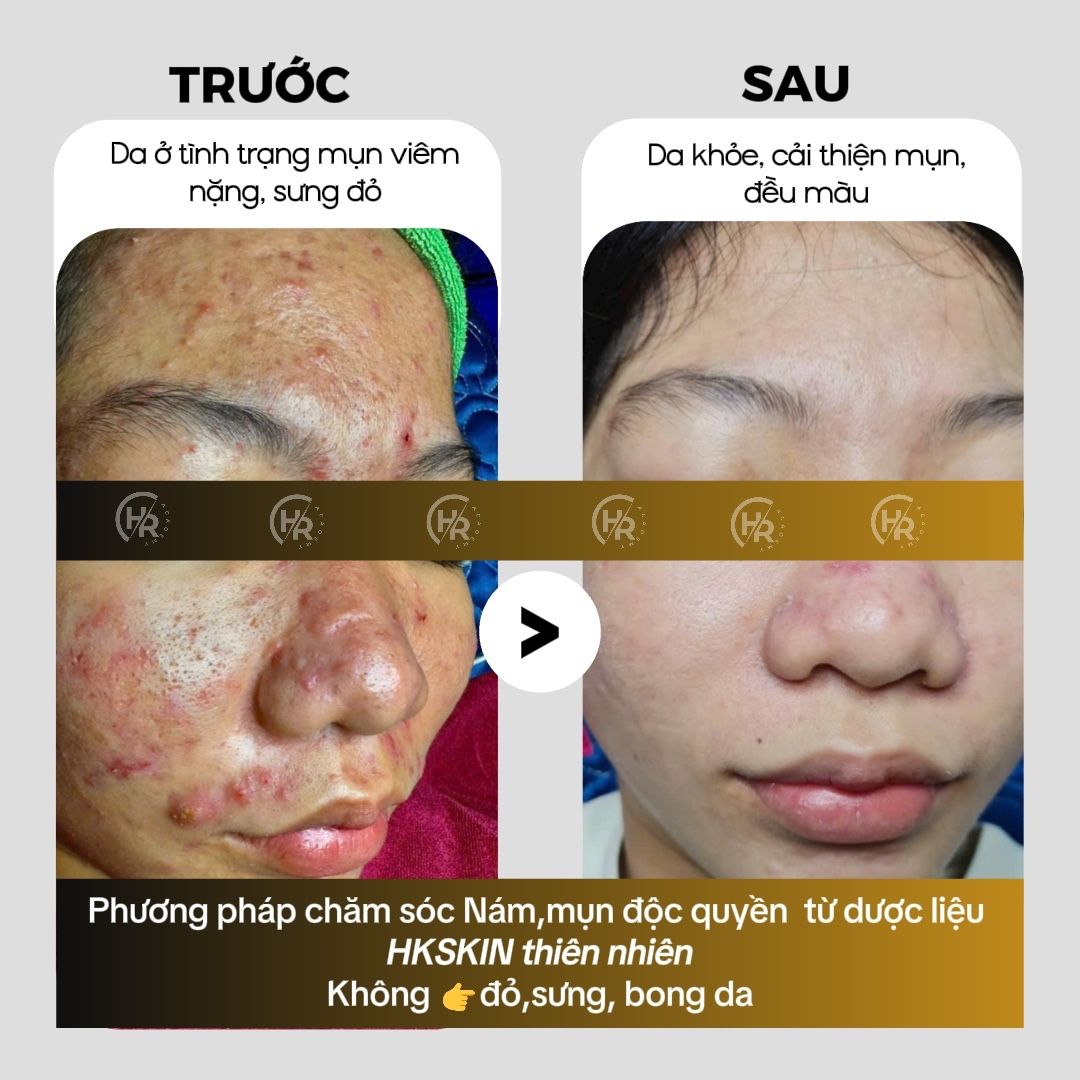 Trị Mụn Viêm Hiệu Quả – Giải Pháp Lấy Lại Làn Da Khỏe Mạnh Và Tự Tin