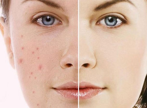 TOP 3 SPA ĐIỀU TRỊ NÁM TÀN NHANG TẠI QUẬN THỦ ĐỨC