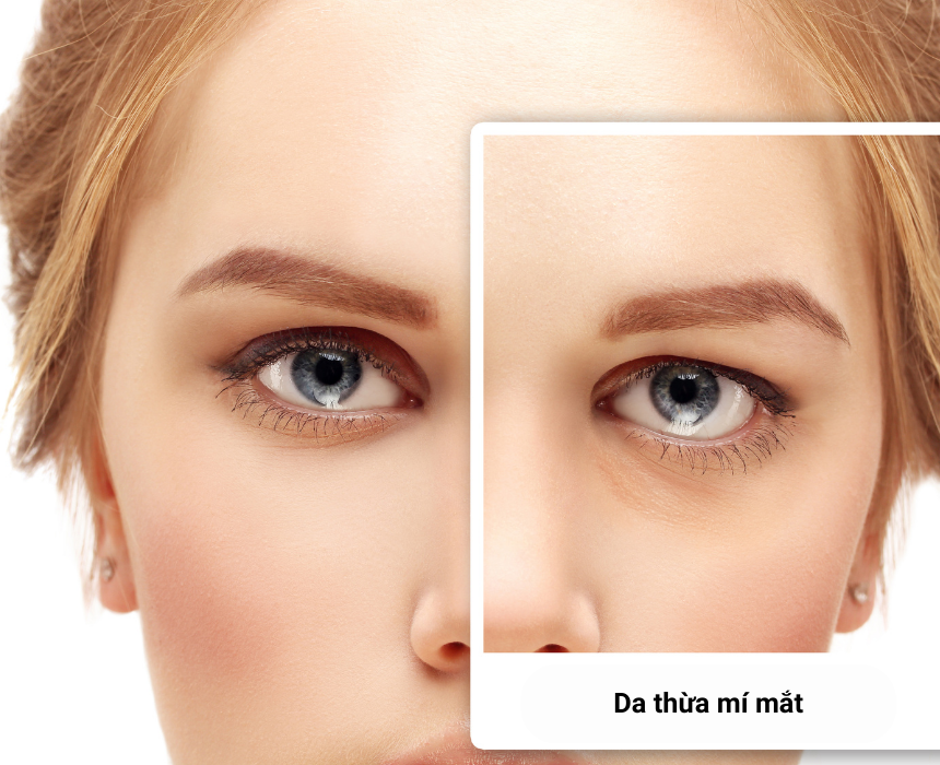 Top 3 Đơn Vị Lấy Da Mỡ Thừa Mí Mắt Dưới Uy Tín Chất Lượng Tại Tân Bình