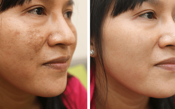 TOP 3 SPA ĐIỀU TRỊ NÁM TÀN NHANG CÓ BẢO HÀNH TẠI QUẬN 6